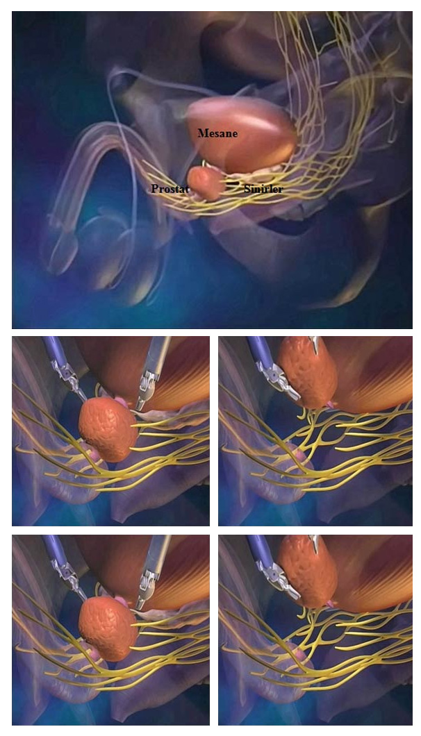 Stages of Robotic Radical Prostatectomy Operation